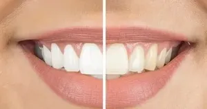 Sararmış dişleri beyazlatmanın sırrı!