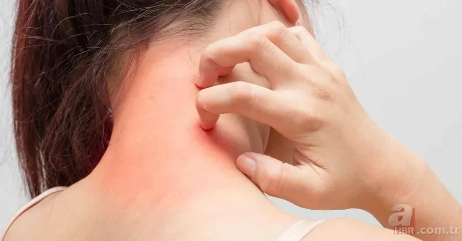 Uyuz hastalığı nedir, belirtileri neler? İnsandan insana uyuz nasıl geçer, kaşıntıya ne iyi gelir, tedavisi var mı? 6