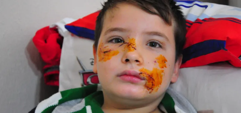 Bir köpek saldırısı haberi daha! 8 yaşındaki Mert'in yüzüne 60 dikiş atıldı