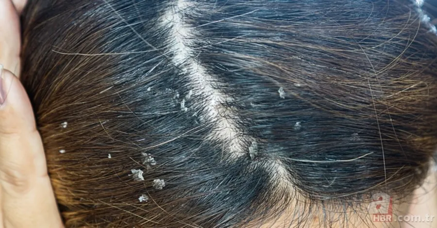 Egzamanızı tek 1 damlasıyla tarihe gömüyor! Saç kökünde kaşıntı, kepek, ağrı şikayetiniz varsa... 10