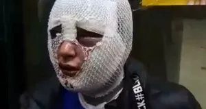 Eski sevgilisinin yüzünü kızgın yağ ile yakmıştı!