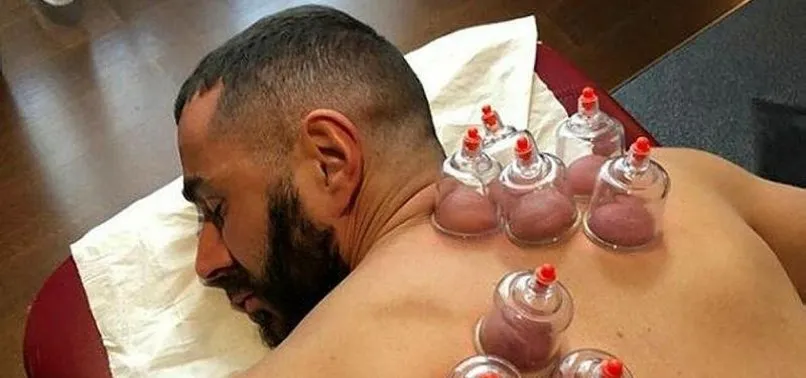 Fransız oyuncusu Karim Benzema hacamat yaptırdı