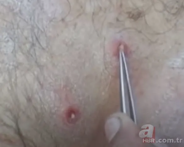 Sırtındaki yarayı sivilce zannetti ama gerçek dehşete düşürdü! Bakın içinden ne çıktı 23