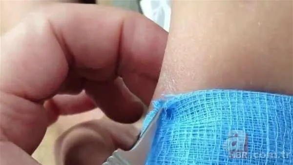 Genç kadının kolundan çıkanlar şoke etti 5