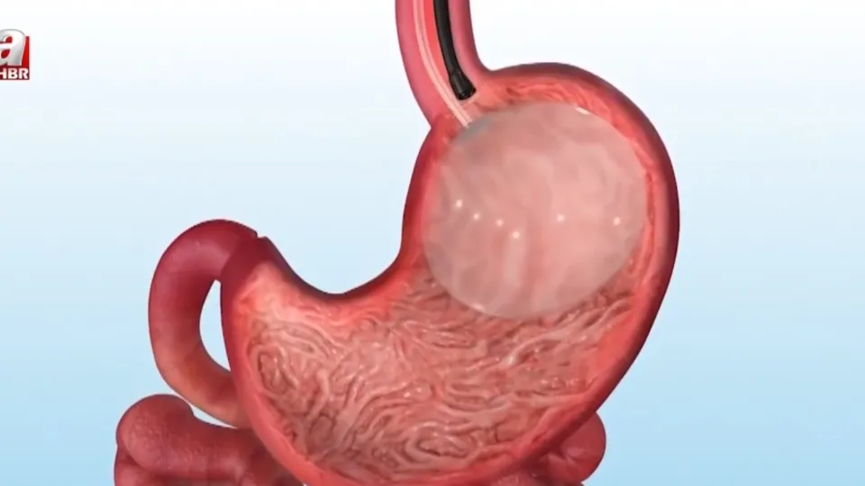 Yutulabilir mide balonu yasaklandı!