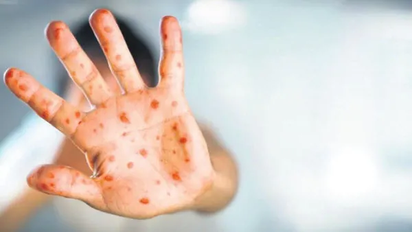 Maymun çiçeği virüsünün belirtileri nelerdir? Ölüm riski düşük ama çok acı çektiriyor | Maymun çiçeğinin iyileşme süreci ne kadar?