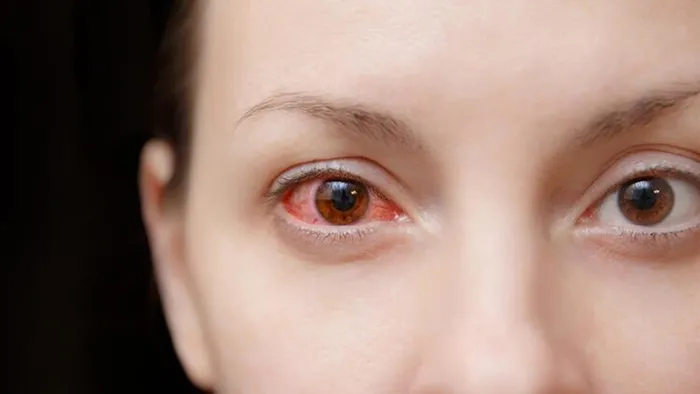 Göz alerjisi neden olur? Belirtileri ve tedavi yöntemi...