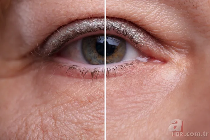 Göz çevresindeki kırışıklıklara doğal çözüm! Haftada 3 kez kullanımla tamamen yok olacaklar 1