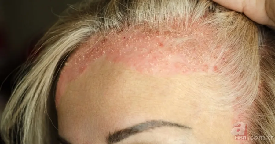 Egzamayı 24 saat içinde yok oluyor! Yarım litre suya bir tutam eklemeniz yetecek! 4