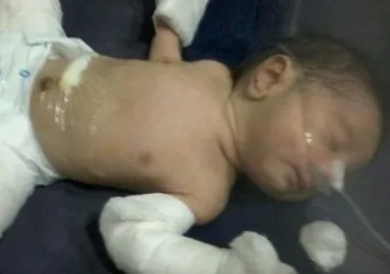 Hindistan'da bir bebek 'hamile' doğdu