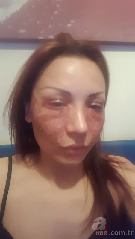 Fatih’te estetik yaptıran Bulgar modelin hayatı kabusa döndü! ‘Örümcek ağı’ operasyonu bakın ne hale getirdi? 7