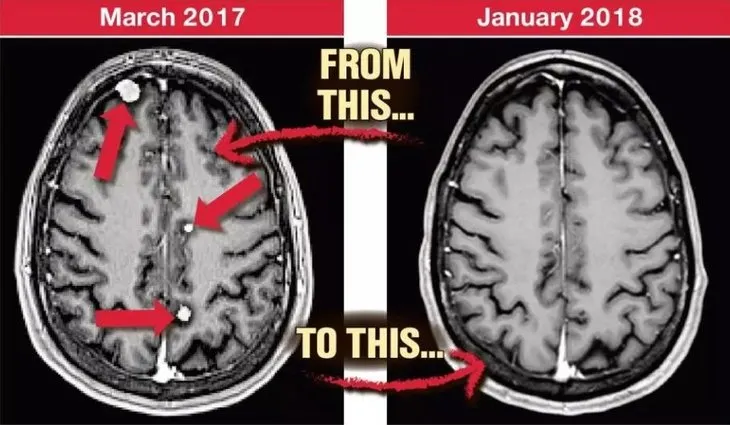 Beyninde 25 tane tümör vardı kendi tedavisini kendisi buldu!