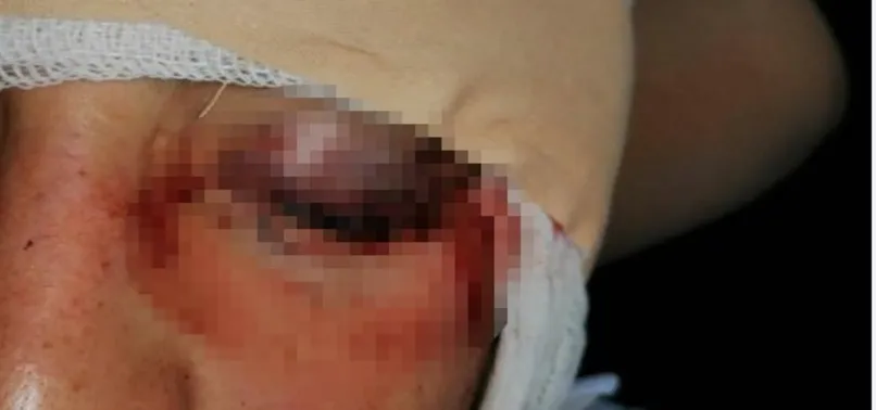 İzmir’de talihsiz genç ayırmaya çalıştığı kavgada gözünden oldu! 3 yıldır sorumluların cezalarını almasını bekliyor