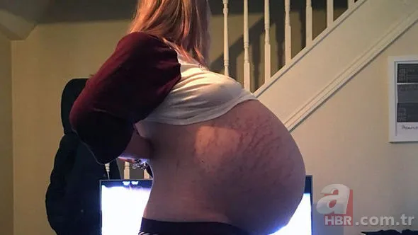 Doktorlar bile hamile sandı! Çıkanlara kimse inanamadı... 1