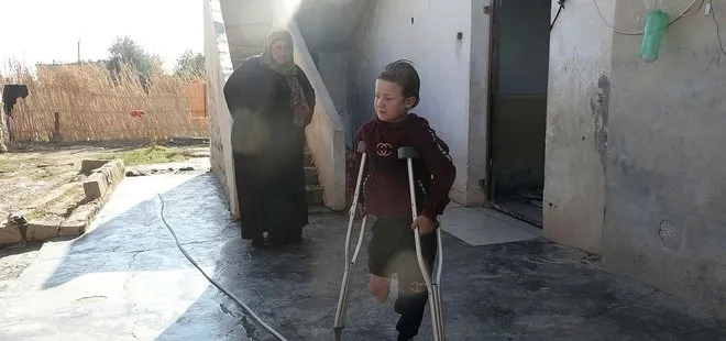 Türkiye’den engellilerin yüzünü protez tedavisiyle güldürüyor