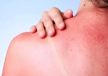 Çocukluk döneminde güneş yanıklarına dikkat
