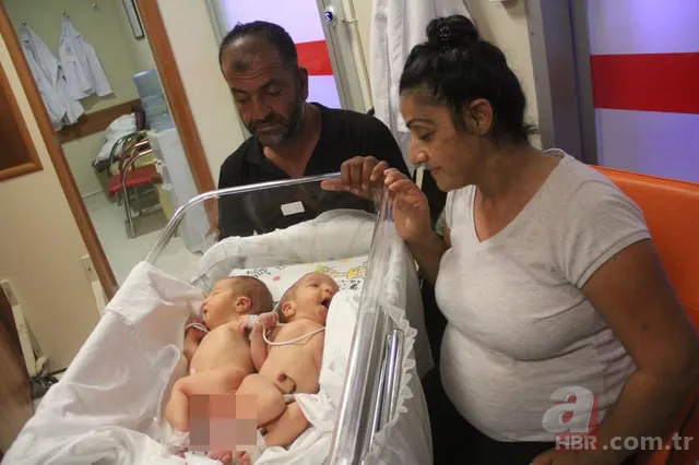 Yapışık ikizler dünyaya geldi 1