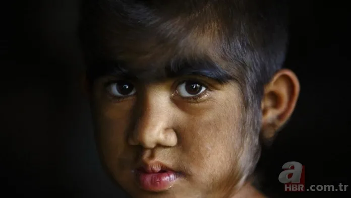 İçtiğiniz ilaçlara dikkat edin! Bebekken kullandığı ilaç kurt adama çevirdi... 3