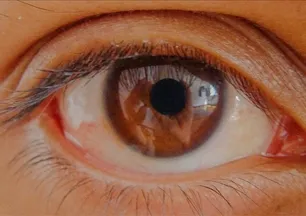 Göz tansiyonunda erken teşhis kalıcı körlüğün önüne geçiyor