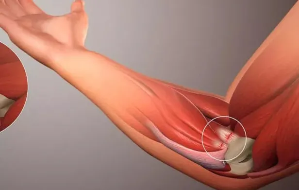 2. derece yırtık iyileşme süresi ne kadar, kaç gün sürer? 2. derece kas yırtılması kaç güne düzelir?