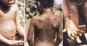 Korona devam ederken yeni kabus! Ölümcül...