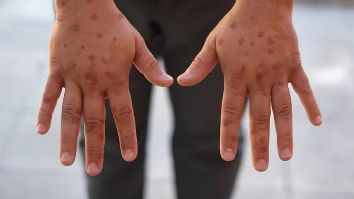 Avrupa’da M çiçeği virüsü uyarısı: Hazırlıklı olunmalı