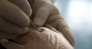 Kene kaynaklı 3 hastalığa dikkat!