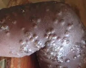 Maymun çiçek virüsü yeni salgına davetiye çıkardı! Avrupa’da vaka sayısı artışta, tedavisi yok 4