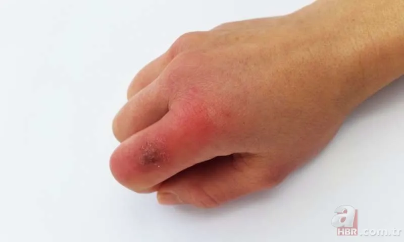 Chilblains ne demek? Chilblains hastalığı belirtileri neler? Galatarasaylı Seri'nin hastalığı Chilblains nedir? 1
