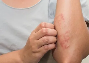 Egzama nasıl geçer? Egzama nedenleri ve belirtileri...