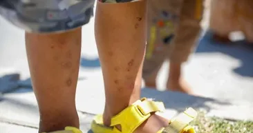 Isırdığı anda beyni küçültüyor! İstanbul’da ’Aedes’ tehlikesi