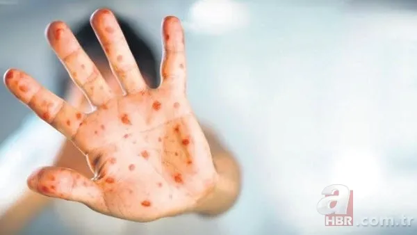 Maymun çiçeği virüsü Türkiye'de var mı? Sağlık Bakanı Fahrettin Koca açıkladı! Maymun çiçeği hastalığı belirtileri nedir? 2