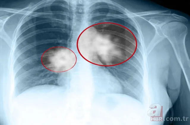 Akciğer kanseri belirtileri nelerdir? 9