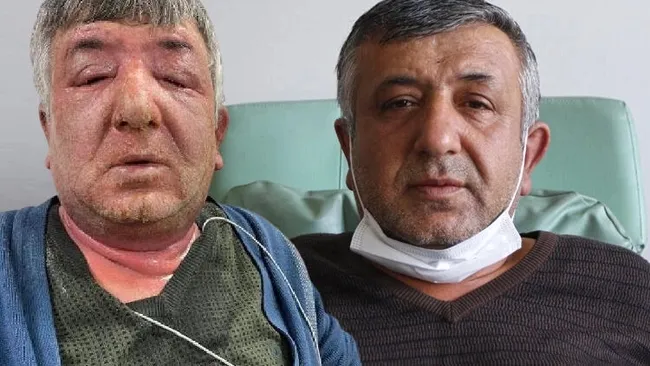 Taksici müşterinin koronavirüs olmasında şüphelenip yüzüne 3 gün boyunca dezenfektan sürünce hastanelik oldu - 2