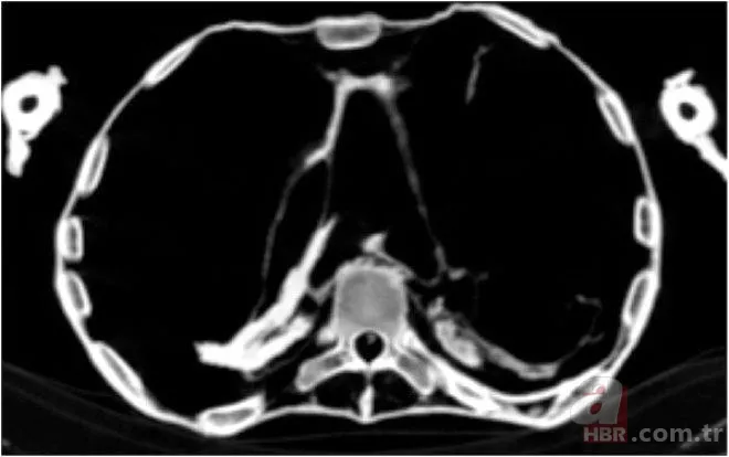 Gizemli iskeletin sırrı çözüldü! Uzaylıya mı ait? UFO teorileri üzerinde duruluyordu… Gerçek bambaşka çıktı 12