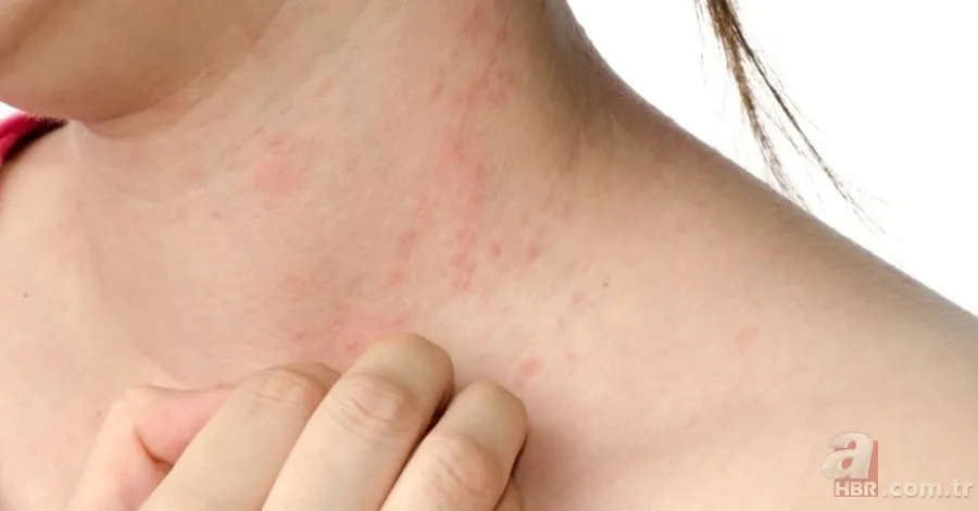 Kurdeşen dökmek ne demek? Kurdeşen (ürtiker) nedir, neden olur, sebepleri neler? Tedavisi var mı, ne iyi gelir? 5