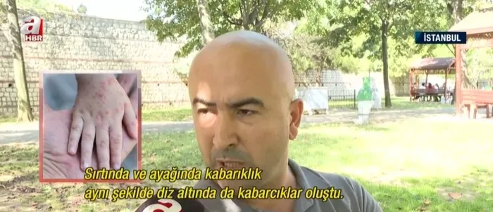 cocuklarin-kabusu-el-ve-ayak-hastaligi-en-net-belirtisi-ates-ve-vucuttaki-dokuntuler-1728762535215.jpg Çocukların kabusu 'el ve ayak hastalığı'! En net belirtisi ateş ve vücuttaki döküntüler - 4