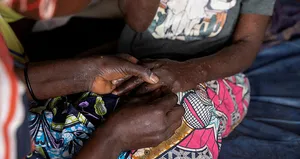 Gana’da M çiçeği vaka sayısı 494’e yükseldi