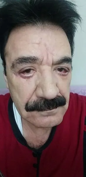En Iyi Burun Estetigi Yapan Doktor