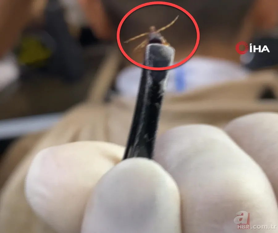 Tıraş olmaya gitti hayatının şokunu yaşadı! Kafasından çıkan dehşete düşürdü… Hayatı kurtuldu 6