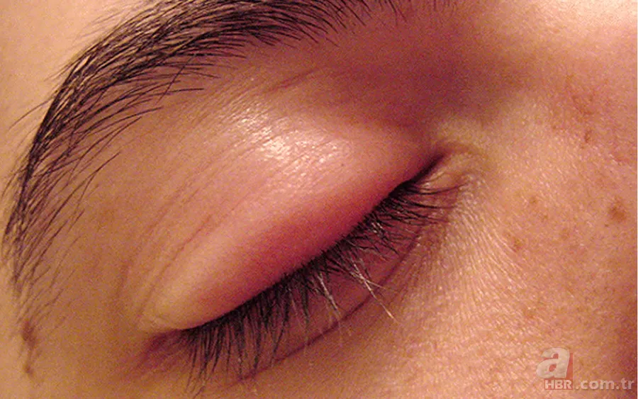 Gözde arpacık neden çıkar, nasıl geçer? 10