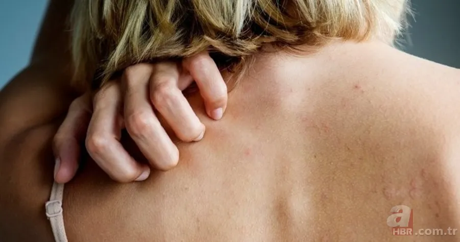 Bu belirtiler varsa dikkat! Ciltte geçmeyen kaşıntı kızarıklık... Uyuz neden olur, tedavi yöntemi nelerdir? Hastalık tanısı... 4