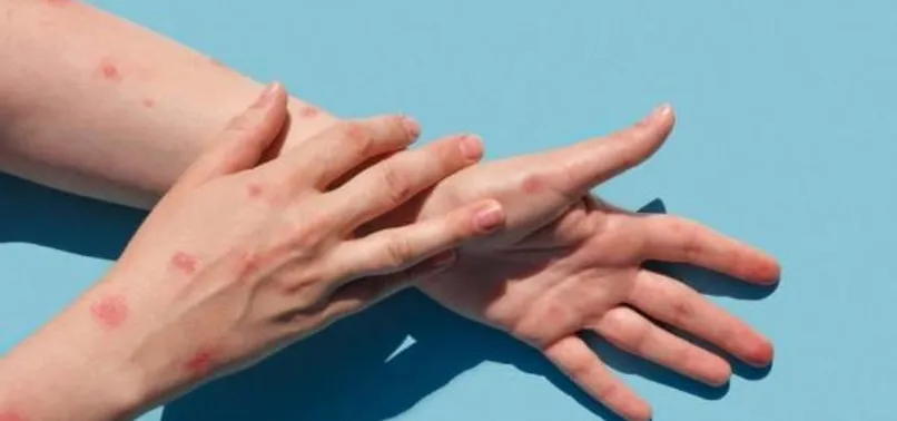 Son dakika: Maymun çiçeği hastalığı Türkiye'de! Sağlık Bakanı Fahrettin Koca duyurdu | Maymun Çiçeği hastalığı hangi ilde görüldü