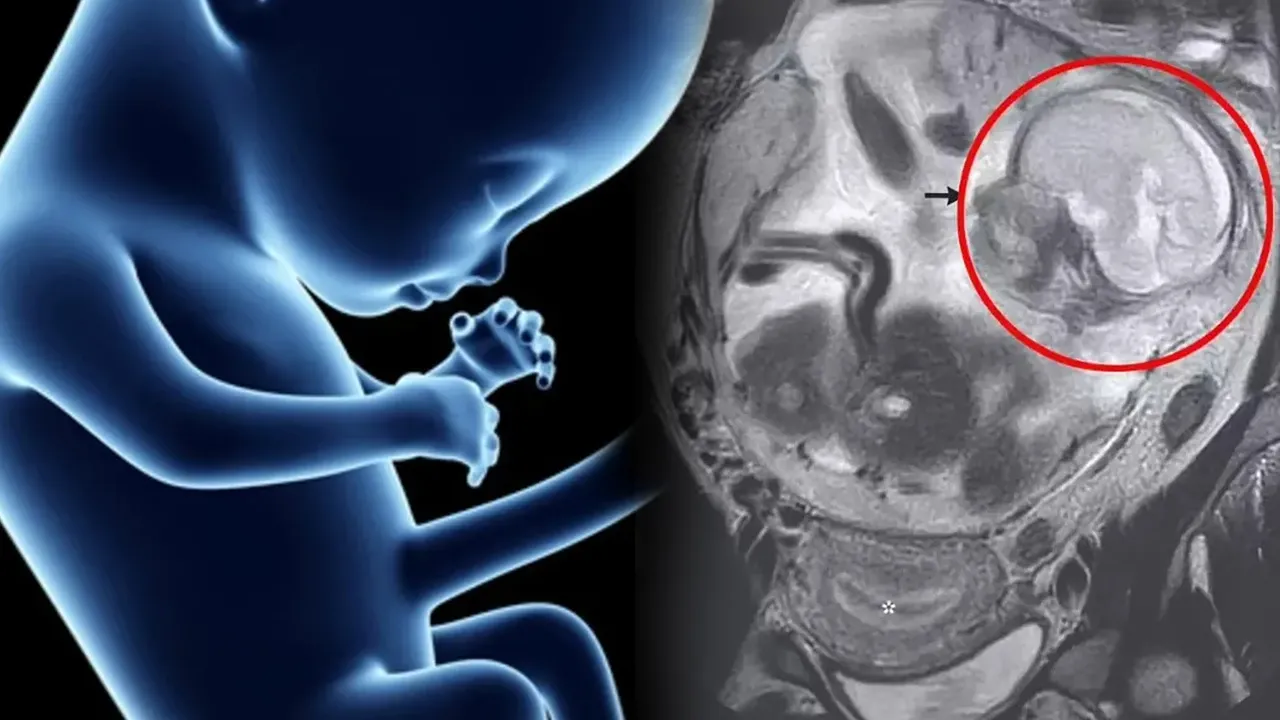 Bağırsakta büyüyen bebek olayı şoke etti! Doktorlar gördükleri karşısında dondu! Meğer 5,5 aylık...