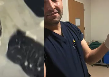 Şaşkına çeviren olay! Nefes darlığı ve öksürük sebebi "ceviz" çıktı