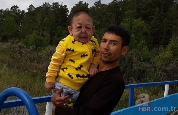 Dünyanın en tuhaf hastalıkları 6