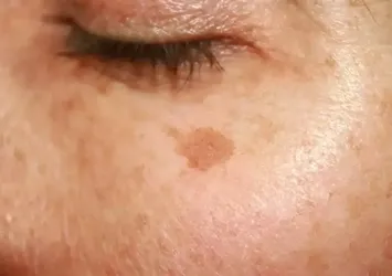 Güneş lekeleri nasıl geçer? Ciltteki kahverengi lekeleri yok eden yöntem...