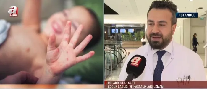 cocuklarin-kabusu-el-ve-ayak-hastaligi-en-net-belirtisi-ates-ve-vucuttaki-dokuntuler-1728762333244.jpg Çocukların kabusu 'el ve ayak hastalığı'! En net belirtisi ateş ve vücuttaki döküntüler - 1