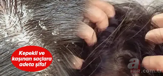 Kaşınan ve kepeklenen saçınız varsa dikkat! Bu yöntemle hem rahatlayacak hem de saçınızı uzatacaksınız 1