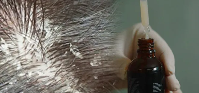 30 dakikada kepeği yok ediyor! Şampuandan etkili yöntem...